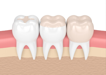 Spring Hope Family Dentistry - Dental Sealants