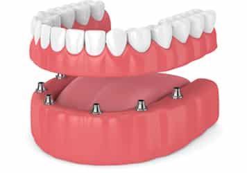 Spring Hope Family Dentistry - Dentures and Partials